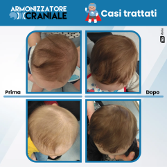 Armonizzatore Craniale - Caschetto Plagiocefalia