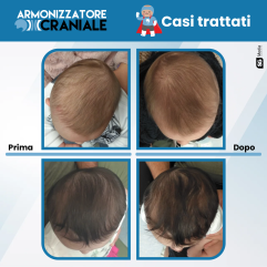 Armonizzatore Craniale - Caschetto Plagiocefalia