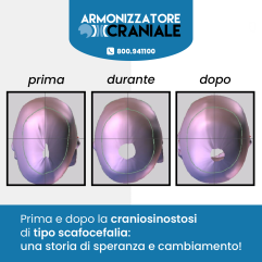 Armonizzatore Craniale - Caschetto Plagiocefalia