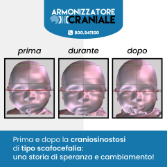 Armonizzatore Craniale - Caschetto Plagiocefalia