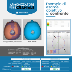 Armonizzatore Craniale - Caschetto Plagiocefalia